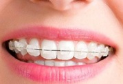 Teeth Straightening - Easy dental Al Karama